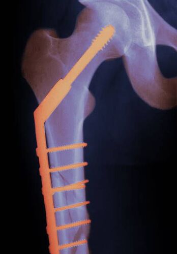 x-ray-of-hip-screw-in-fractured-thigh-bone